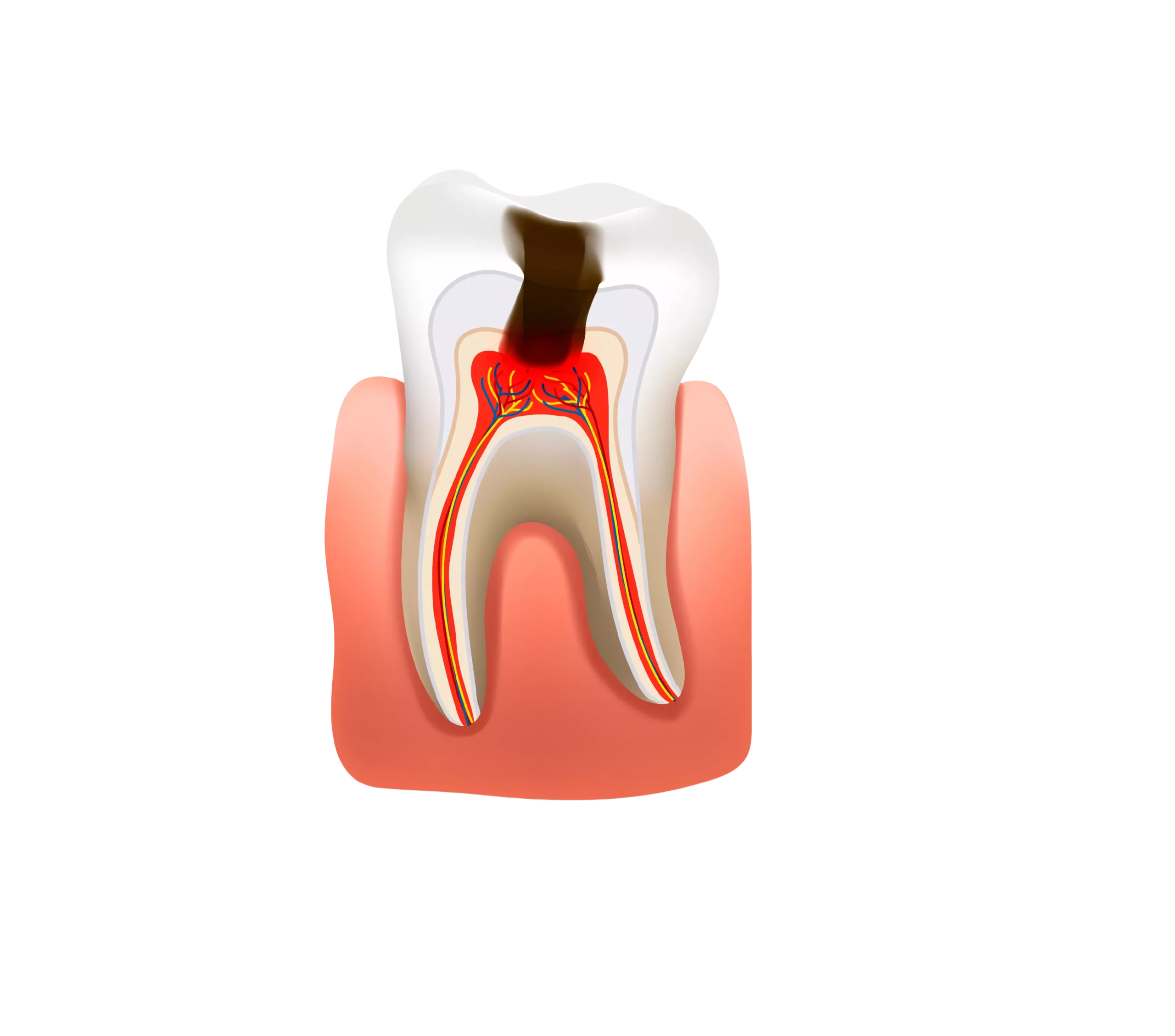 Dente Endodonzia